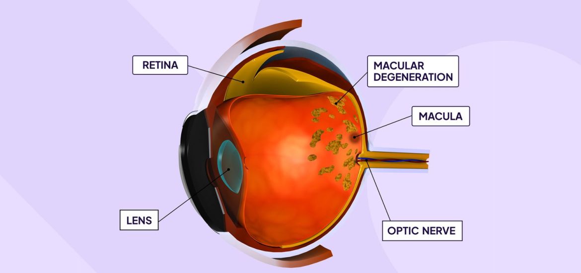 Managing Life with Age-Related Macular Degeneration: Advice for Daily Living