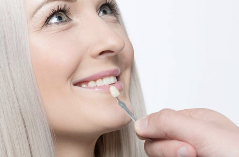 Discovering the Unseen Benefits of Veneers for Oral Health