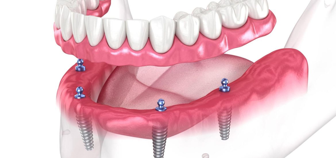 Biting into the Future: How Dental Implants are Redefining Oral Health