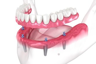 Biting into the Future: How Dental Implants are Redefining Oral Health