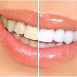 How Veneers Address Tooth Discolouration That Whitening Cannot Fix