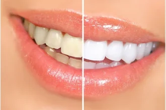How Veneers Address Tooth Discolouration That Whitening Cannot Fix