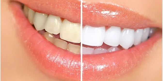 How Veneers Address Tooth Discolouration That Whitening Cannot Fix